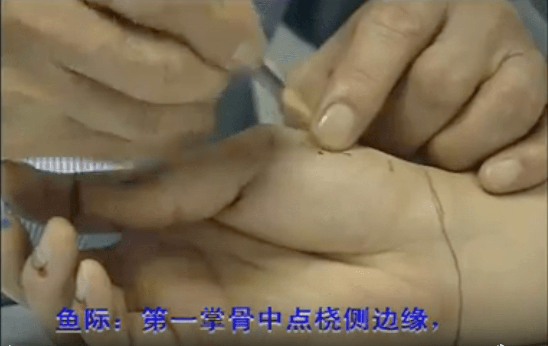 针灸真人配穴取穴