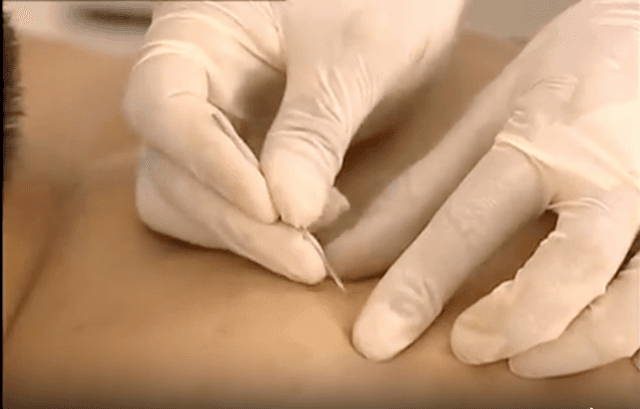 针灸标准操作-三棱针