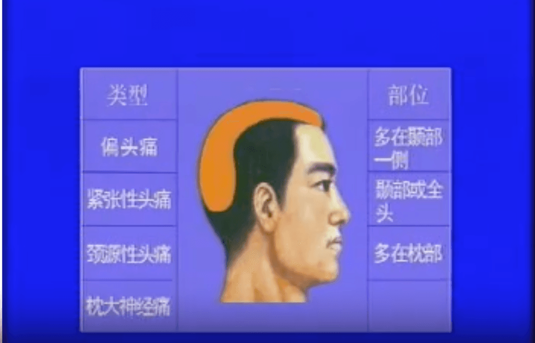 针灸治疗常见头痛