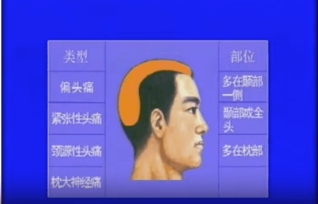 针灸治疗常见头痛